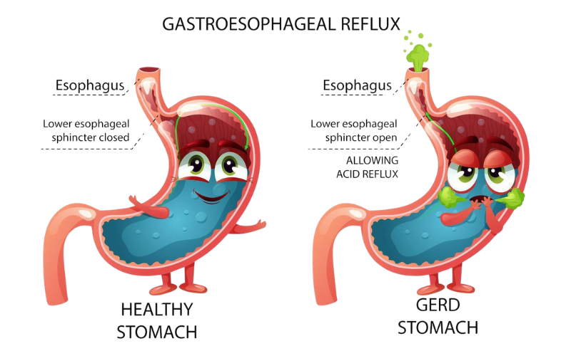 An infographic showing stomach contraction vs. passive esophageal reflux.png